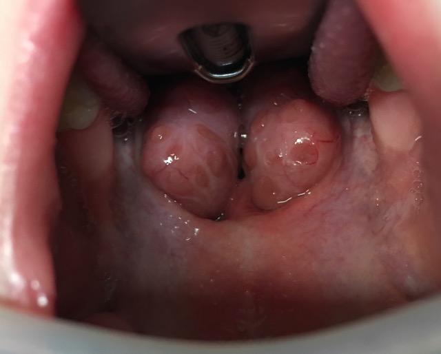 tonsille ostruenti pre-trattamento con coblator